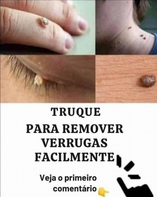 Como remover verrugas com remédios caseiros naturais