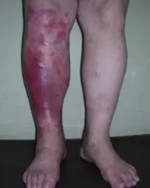 Os primeiros sintomas da inflamação: como reconhecê-los e tratá-los naturalmente